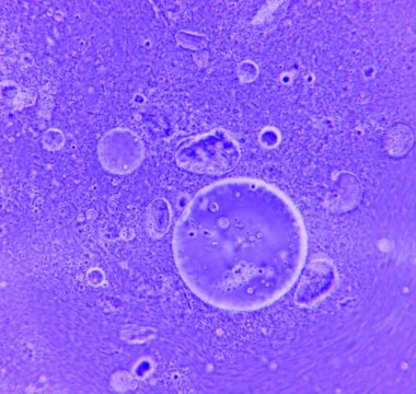 Tau proteininde kritik bölge saptandı: Alzheimer tedavisinde yeni hedef