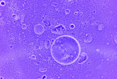 Tau proteininde kritik bölge saptandı: Alzheimer tedavisinde yeni hedef