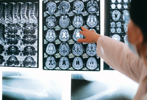 Neuralink, 50.000 Saat Veriyle BCI Rekoru Kırdı: Felçli Hasta “Seni Seviyorum” Dedi
