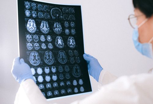 Nörogeribildirim Opioid Bağımlılığında Relapsı %65 Azalttı